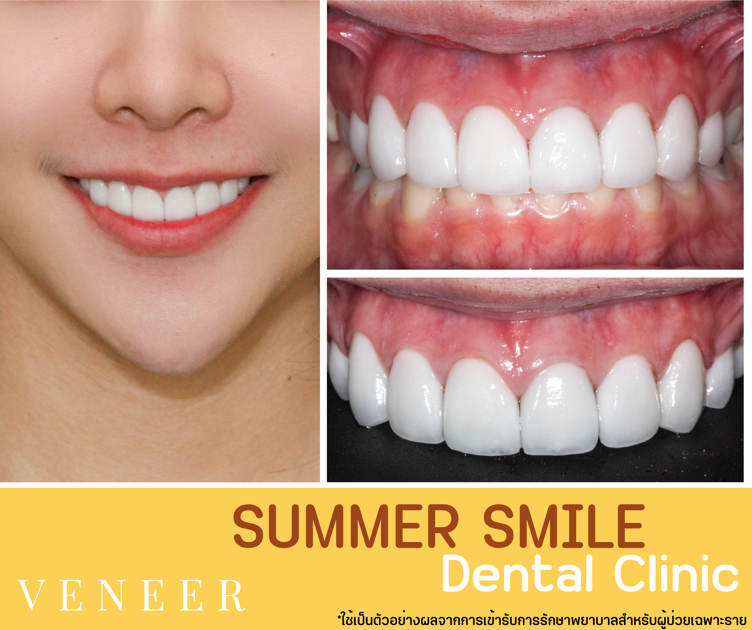 เคสวีเนียร์