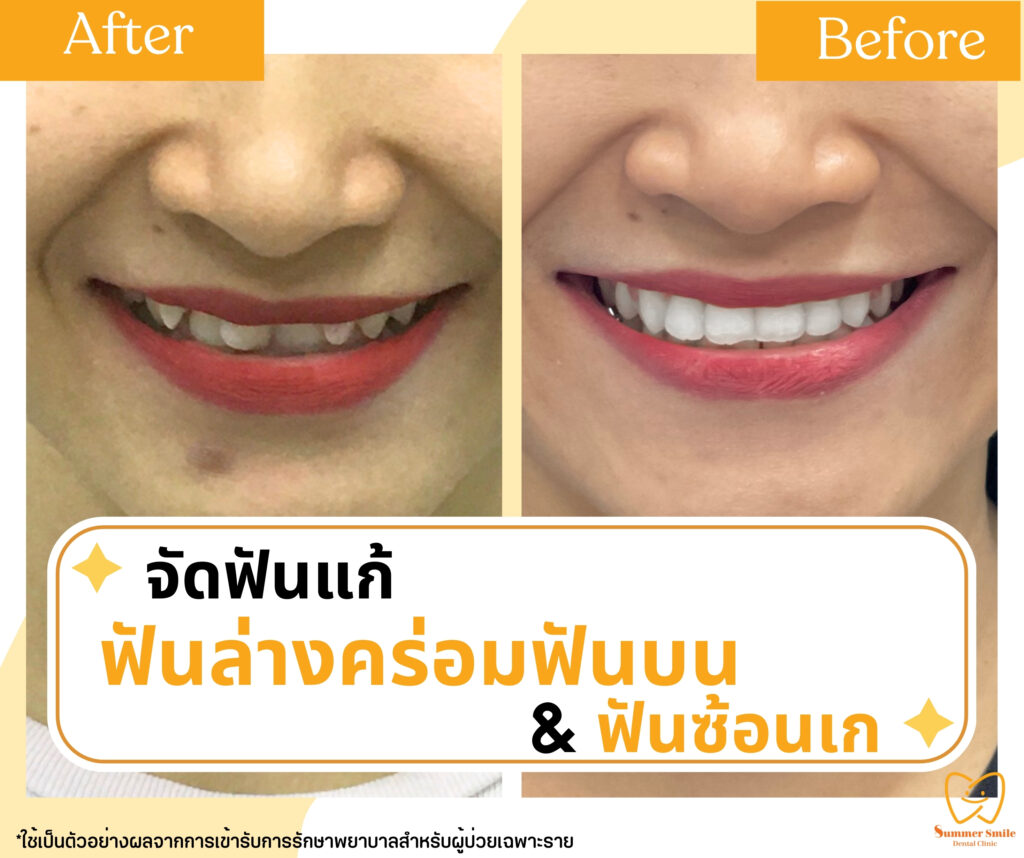 เคสรีวิวจัดฟัน 2.1