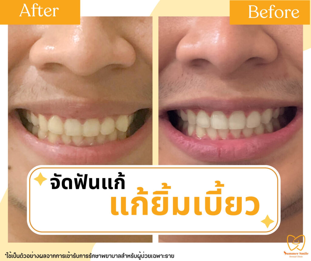 เคสรีวิวจัดฟัน 3.1