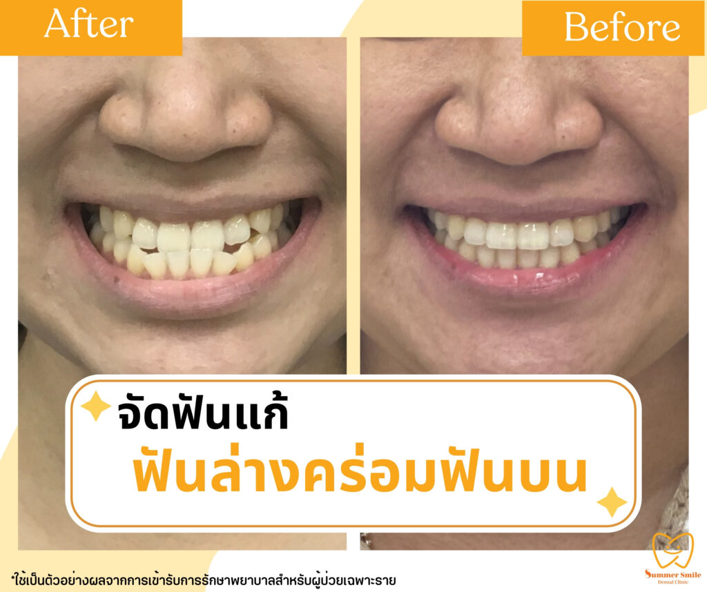 เคสรีวิวจัดฟัน 8.1