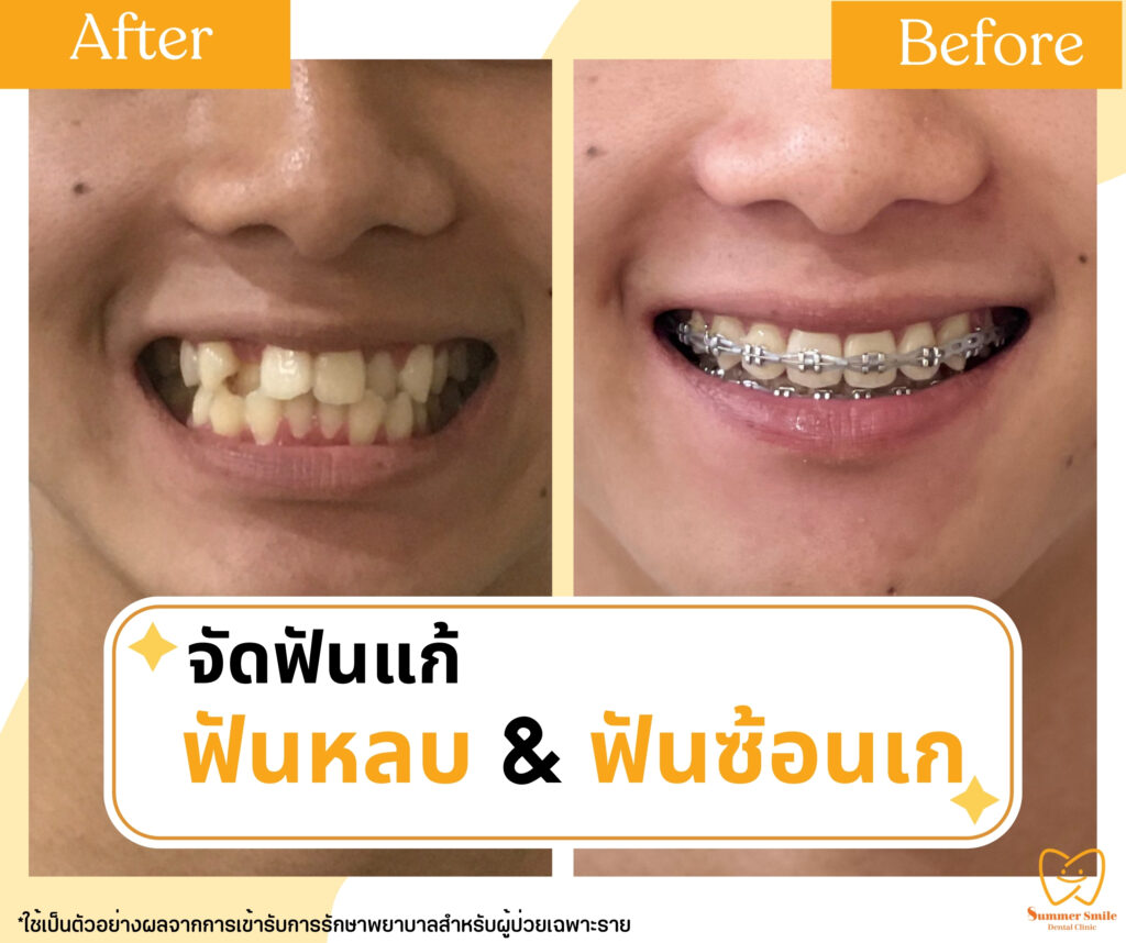 เคสรีวิวจัดฟัน 7.1