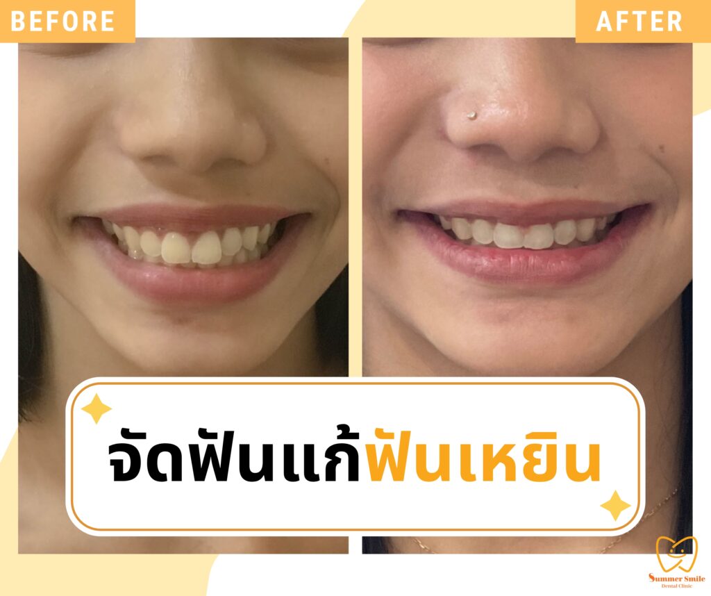 เคสรีวิวจัดฟัน 1.1