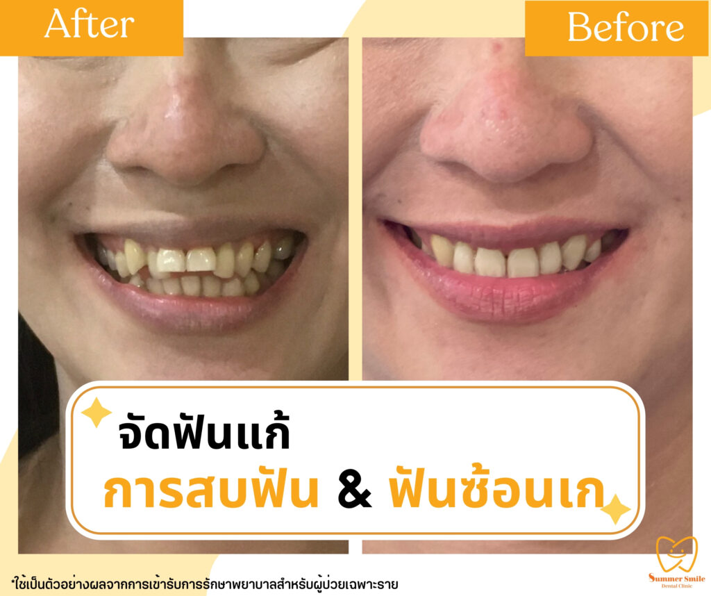 เคสรีวิวจัดฟัน 5.1