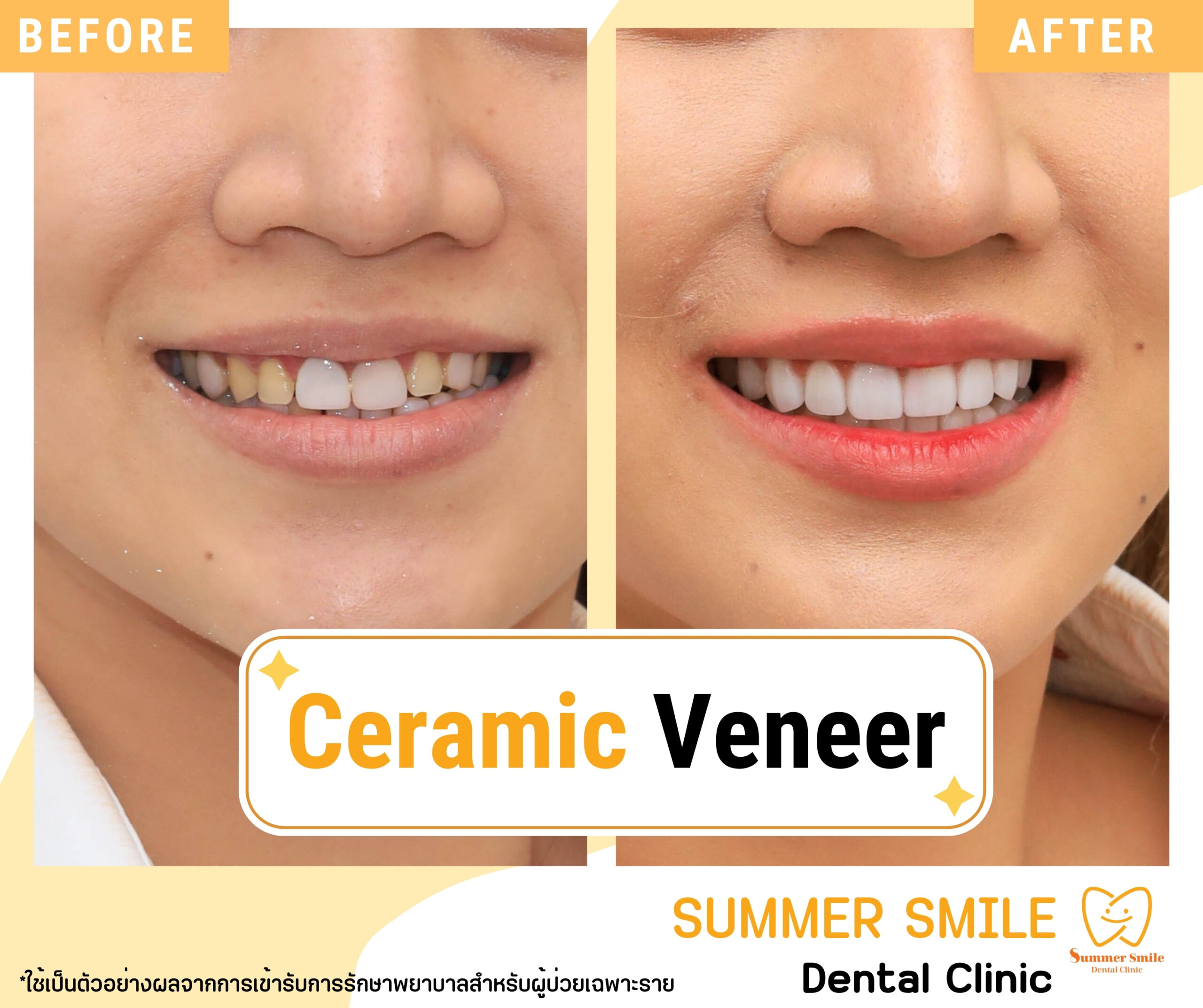 เคสวีเนียร์ 1.2