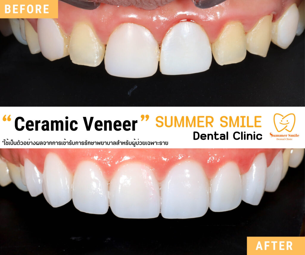 เคสวีเนียร์ 1.4