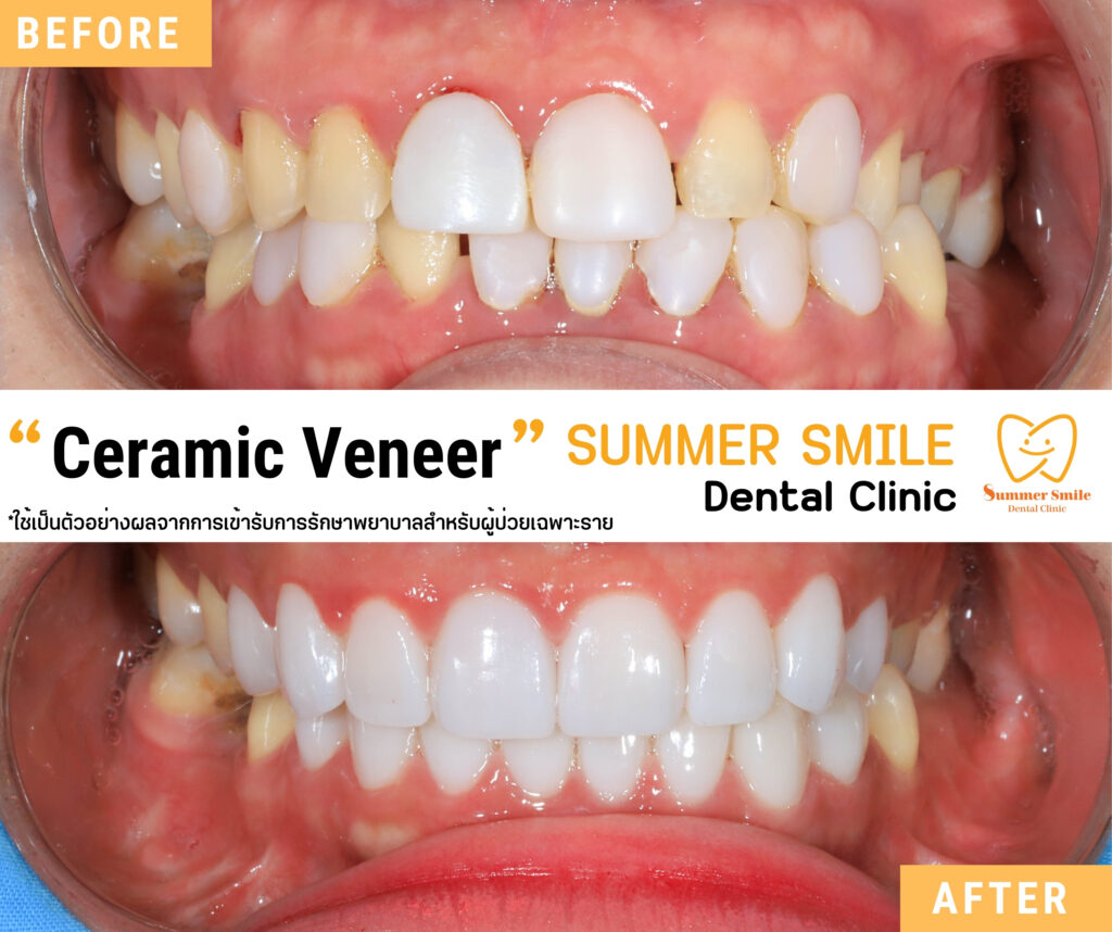 เคสวีเนียร์ 1.5